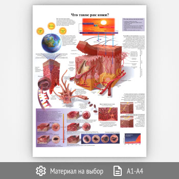 Плакат «Что такое рак кожи?» (ЗОЖ-20, 1 лист)