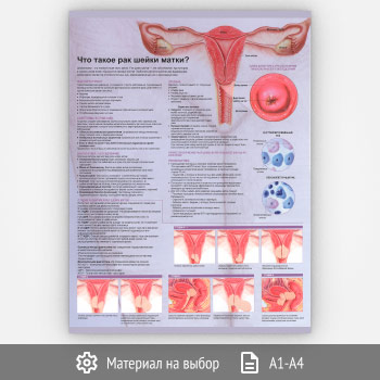 Плакат «Что такое рак шейки матки?» (ЗОЖ-25, 1 лист)