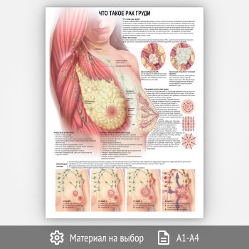 Плакат «Что такое рак груди?» (ЗОЖ-31, 1 лист)