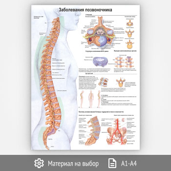 Плакат «Заболевания позвоночника» (ЗОЖ-43, 1 лист)